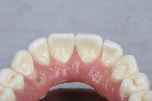 All On   Is A Minimally Invasive Solution For Missing Teeth