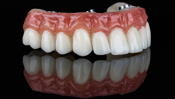 All On Dental Implants: Candidacy, Costs, And Recovery Timeline