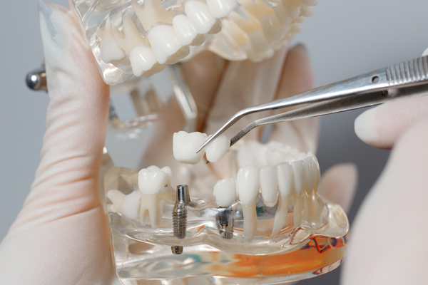 The Difference Between Traditional Crowns And Implant Crowns
