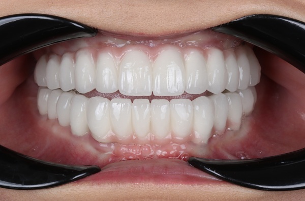 Why Implant Supported Dentures Are A Life Changing Solution For Missing Teeth