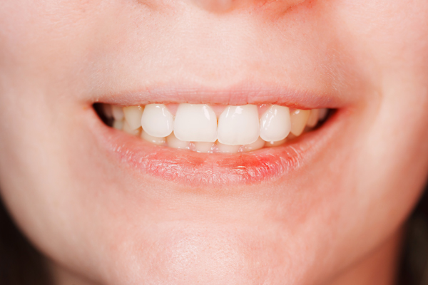 Professional Teeth Whitening Vs At Home Kits: What Works Best?